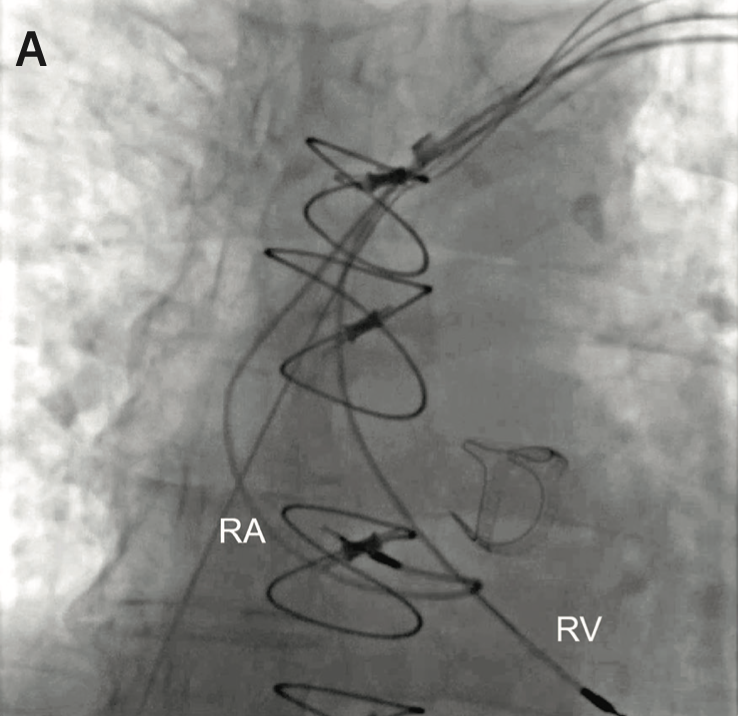 Transvenous Lead Extraction | Risk Stratification Approach